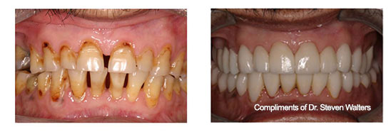 fixed-emax-before-and-after-dr-walters